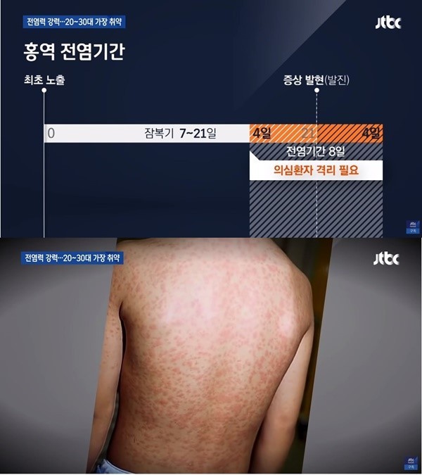 베트남 홍역 점염기간