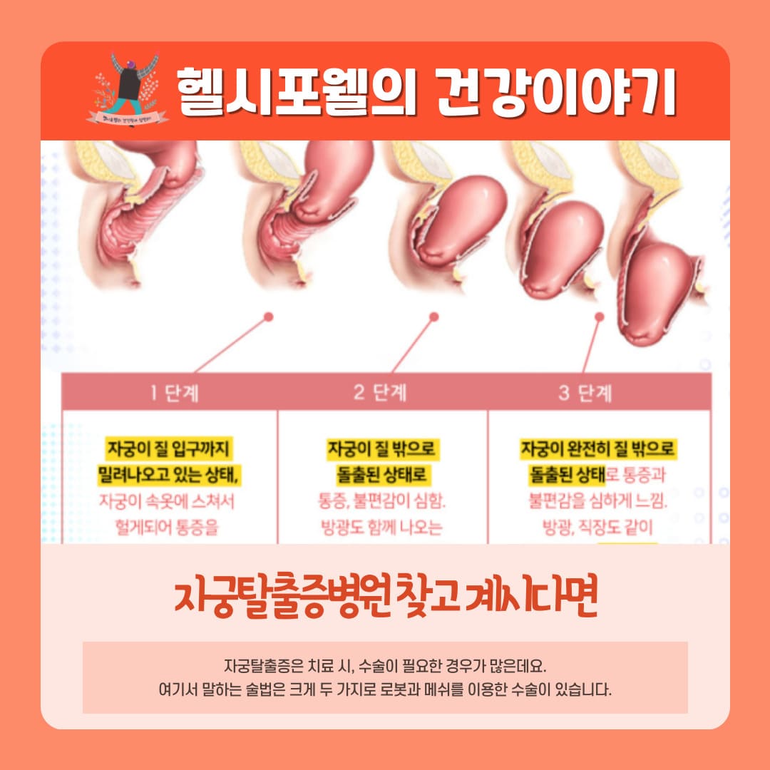 자궁탈출증병원 찾고 계시다면