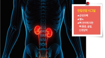 전립선암이미지