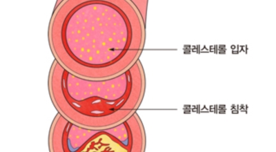 고혈압 이미지