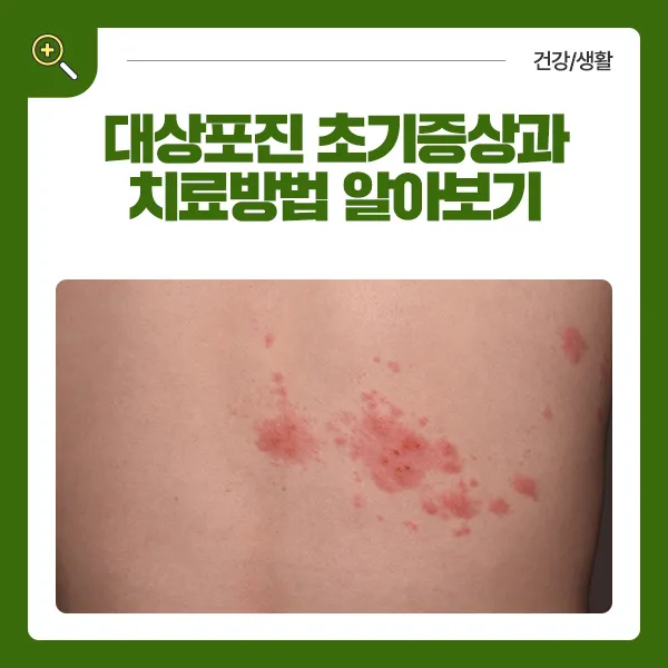 대상포진 치료방법에 대한 총정리 건강 질병관리_5
