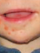 수족구병에 걸린 아이의 입주변