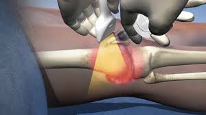 2025년 최신 무릎 연골 주사 종류 비교