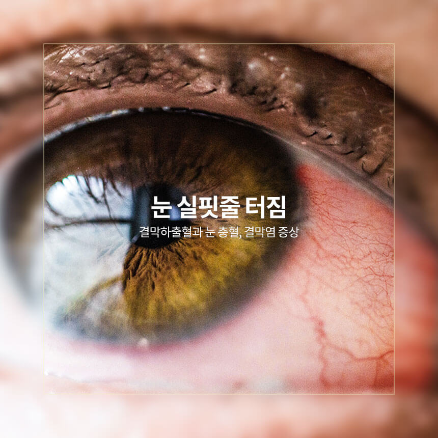 눈 실핏줄 터짐, 각막하출혈, 눈 충혈, 결막염 증상