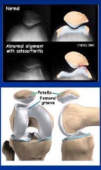 Chondromalacia Patella