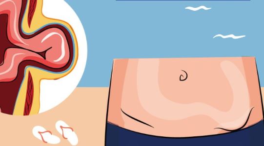 3. 탈장 수술의 종류와 절차