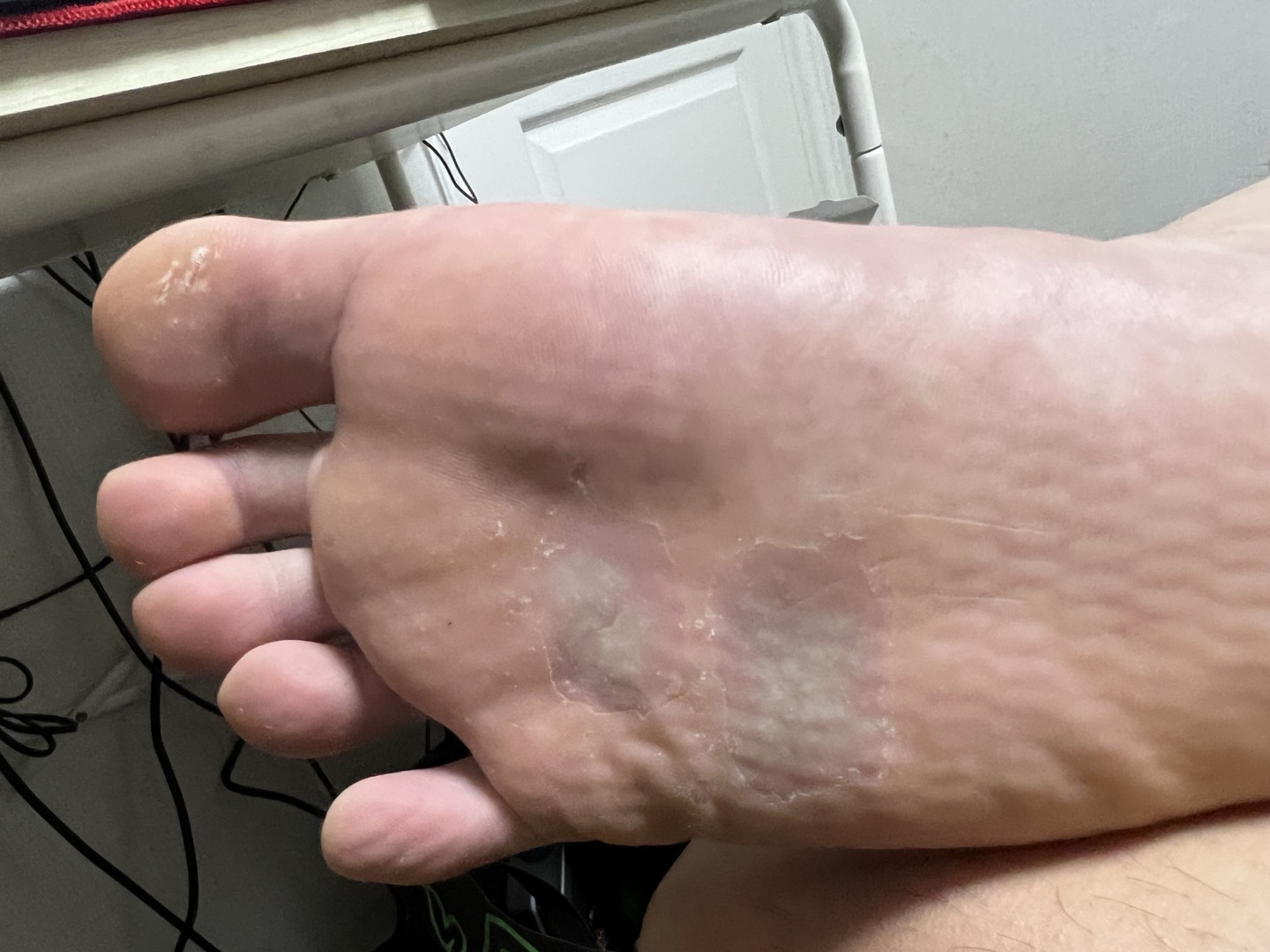 발바닥 사마귀 자가치료