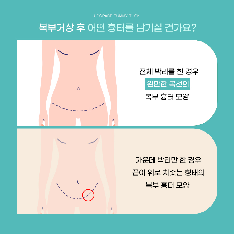 전체 박리를 한 경우 완만한 곡선의 복부 흉터 모양 vs 가운데 박리만 한 경우 끝이 치솟는 형태의 복부 흉터 모양