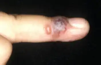 헤르페스-손발톱주위염-이미지