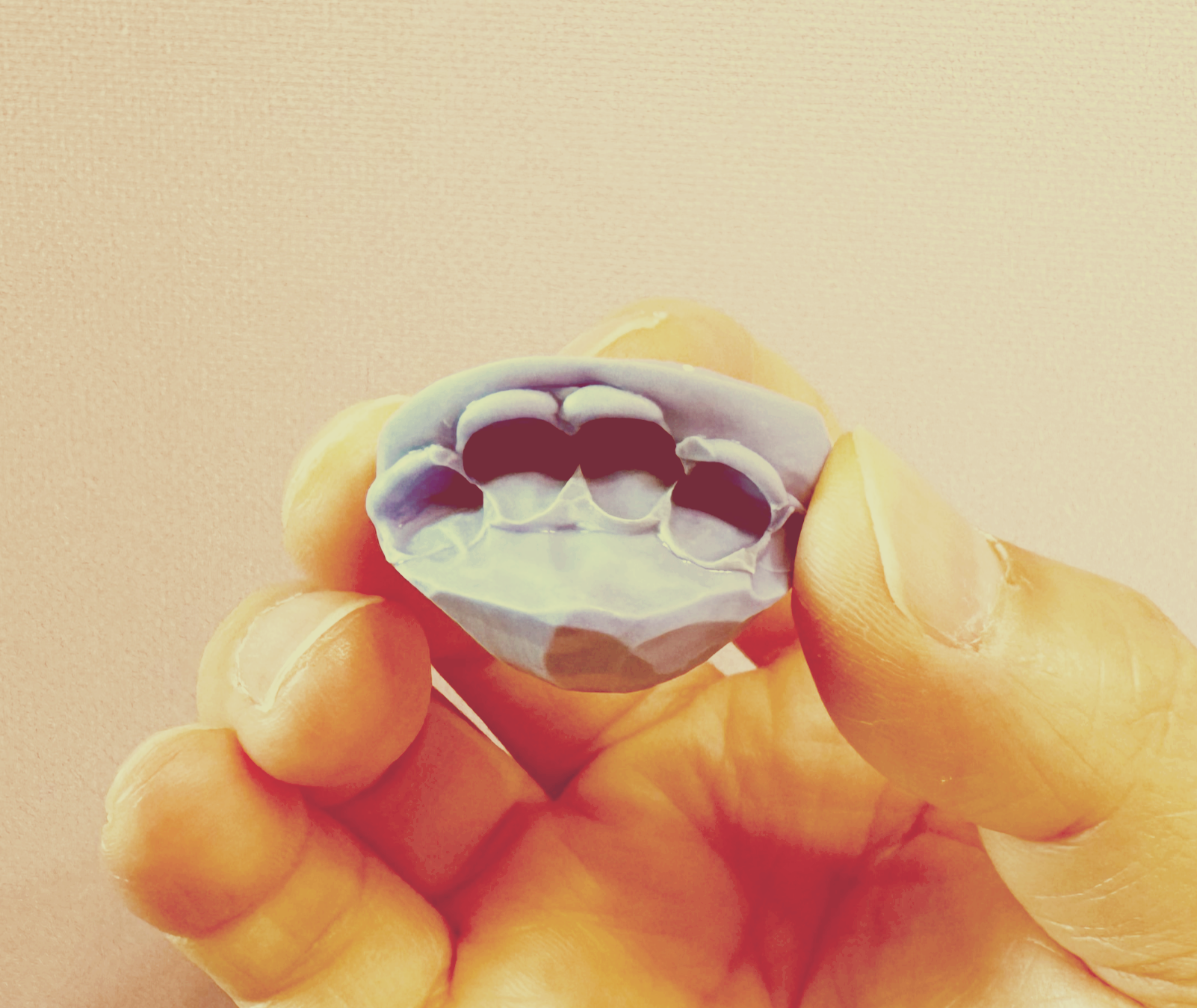 턱관절 치료 임시장치