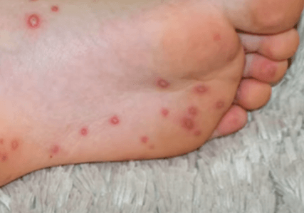 엠폭스 감염 증상으로 발바닥에 수포가 올라온 사진
