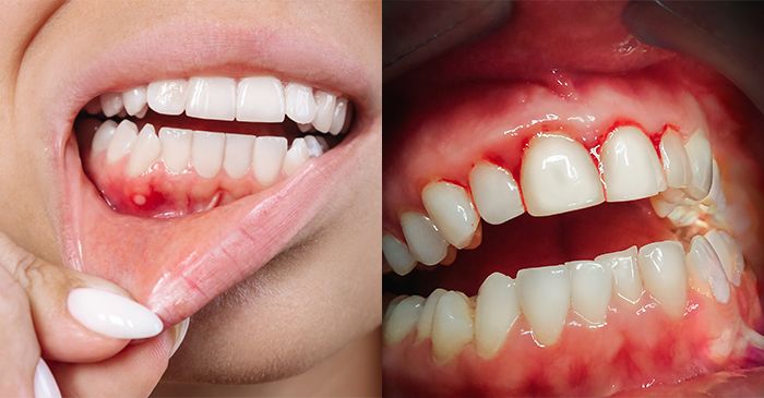 잇몸 염증 / 잇몸 피