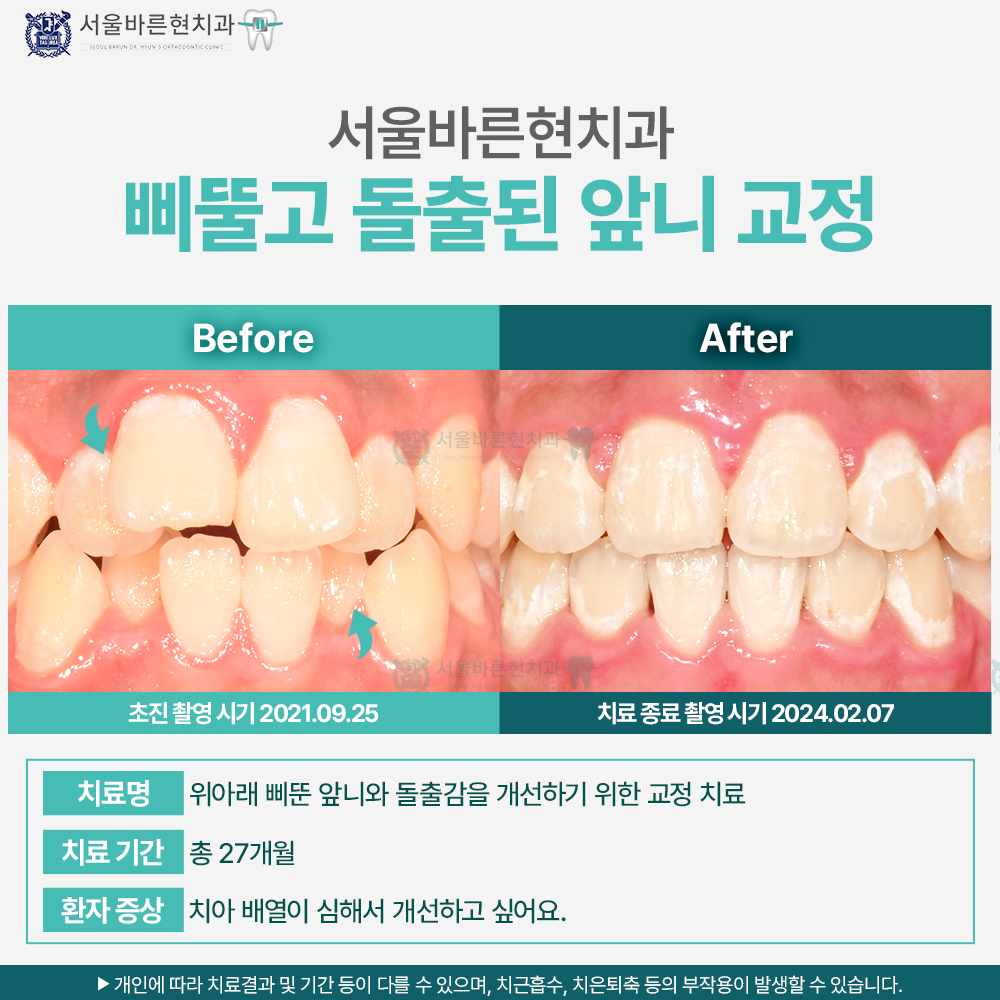 부산치아교정