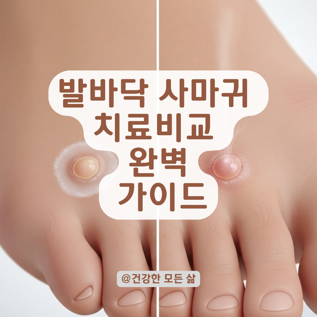냉동치료부터 레이저까지, 발바닥 사마귀 치료법 비교 정리.