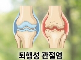 연골주사 맞고 운동해도 될까? 슬로우 조깅 시작 시기 총정리