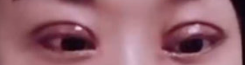 쌍꺼풀 수술 부작용