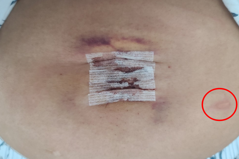 배꼽 수술부위와 물집