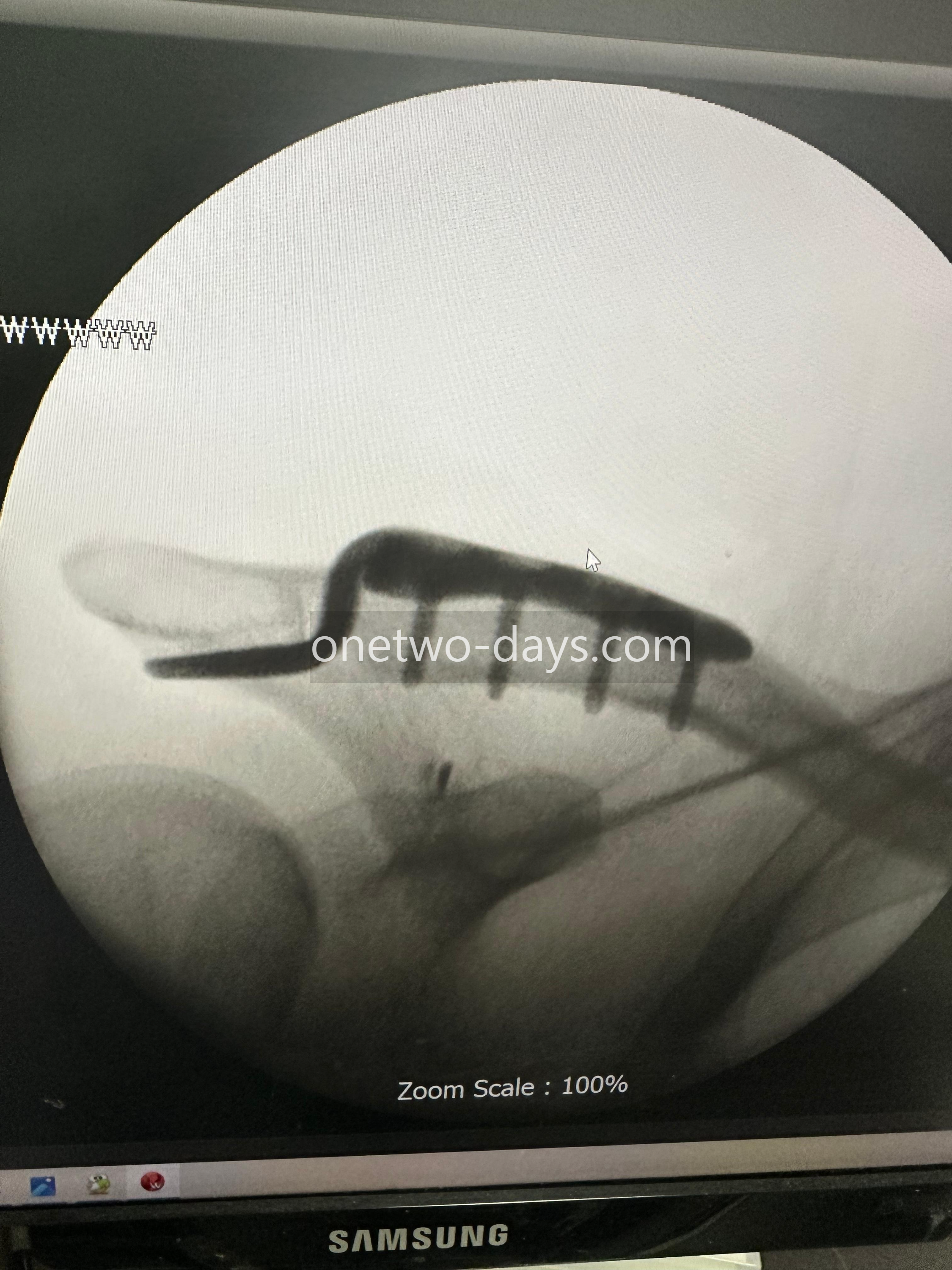 견쇄관절탈구 후크플레이트 수술