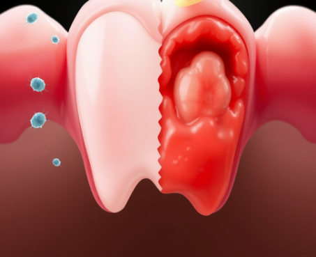 화이니카-치탄플러스-내돈내산-후기-치석-제거-효과