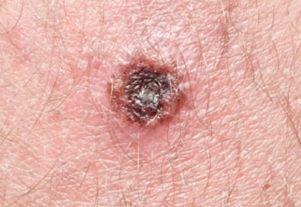 쯔쯔가무시 초기 증상 검은 반점