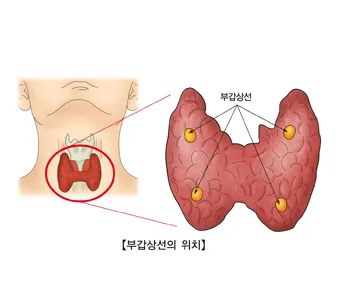 부갑상선기능항진증 수술 후기 2주차 내분비외과 내원 경험담_1