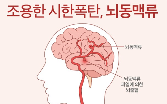 뇌동맥류와 지주막하출혈의 위험성 관련 이미지