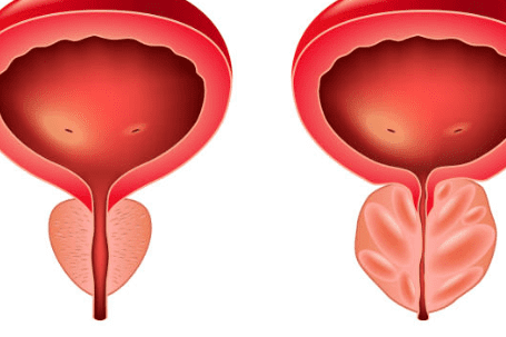 전립선 비대증 치료약