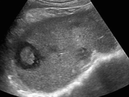 Liver metastases (전이성 간암)