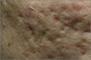 여드름 흉터 없애는법