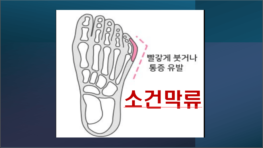 소건막류: 새끼발가락의 경고 신호