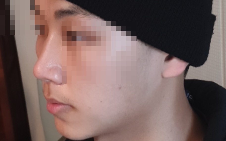 비중격 만곡증 수술 후기