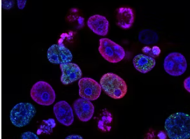 대장암-초기증상