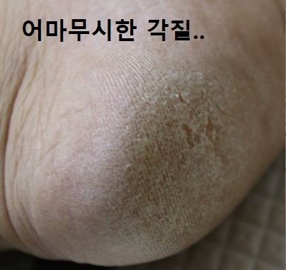 뒤꿈치-각질