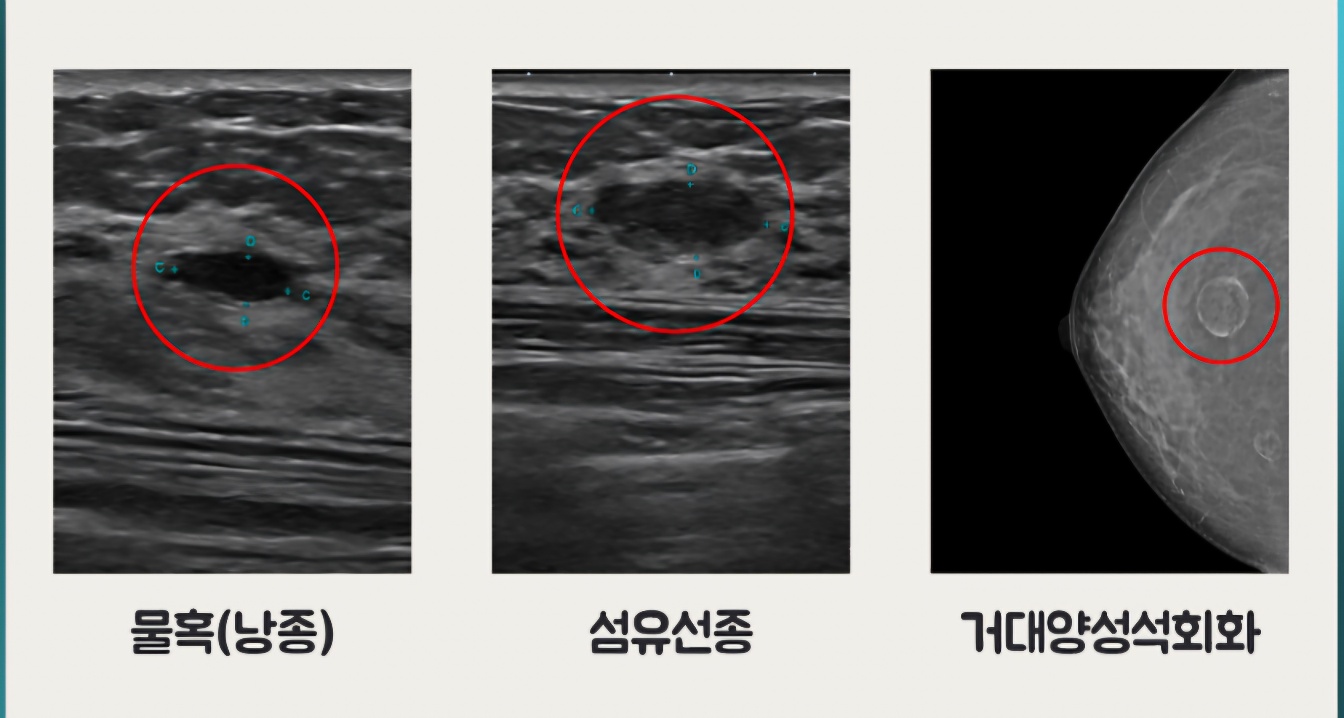 유방 물혹, 섬유선종, 석회화 사진