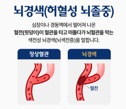 허혈성 뇌졸중 과 출혈성 뇌졸중 관련 사진