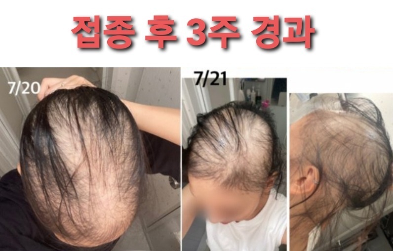 모더나백신부작용/