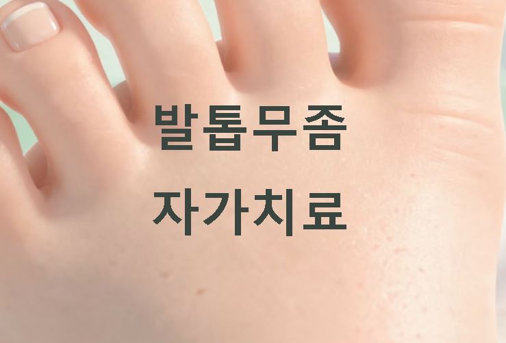 발톱 무좀 자가치료