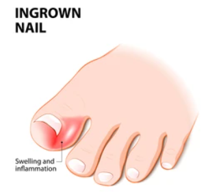 내성발톱 자가치료