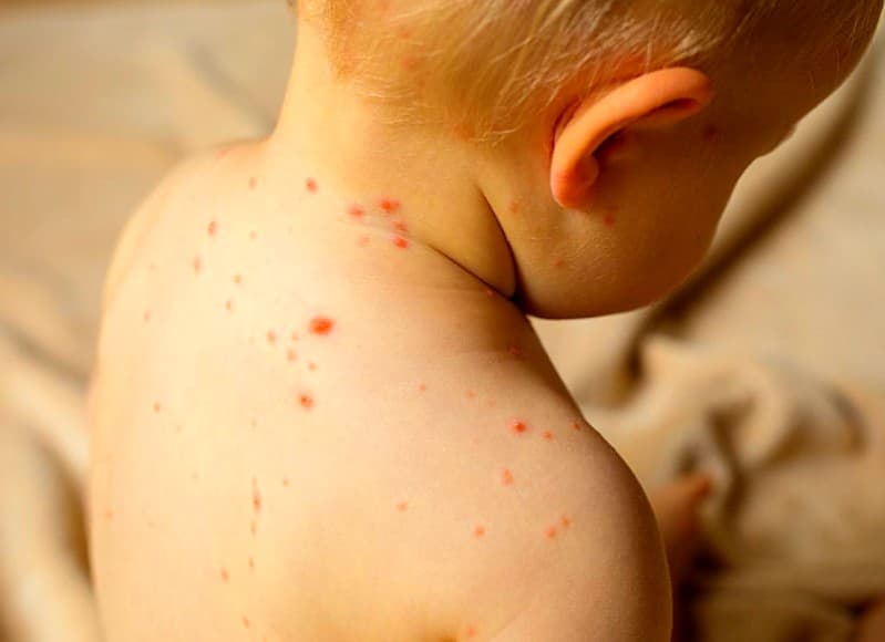 수두(VZV 감염증): 증상, 치료, 예방법