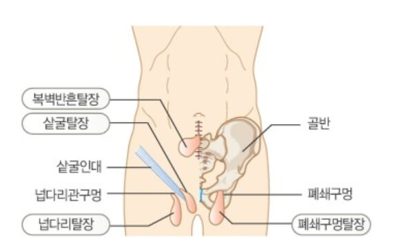 위치에 따른 탈장