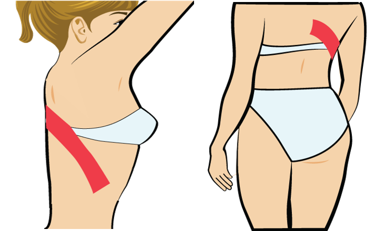 늑간근 테이핑법