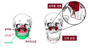 무절개 임플란트