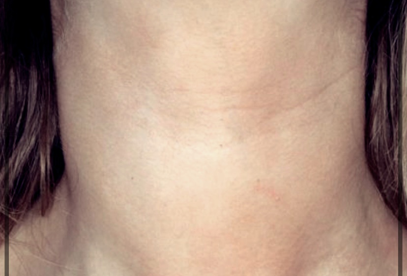 갑상선 부음의 원인과 치료법