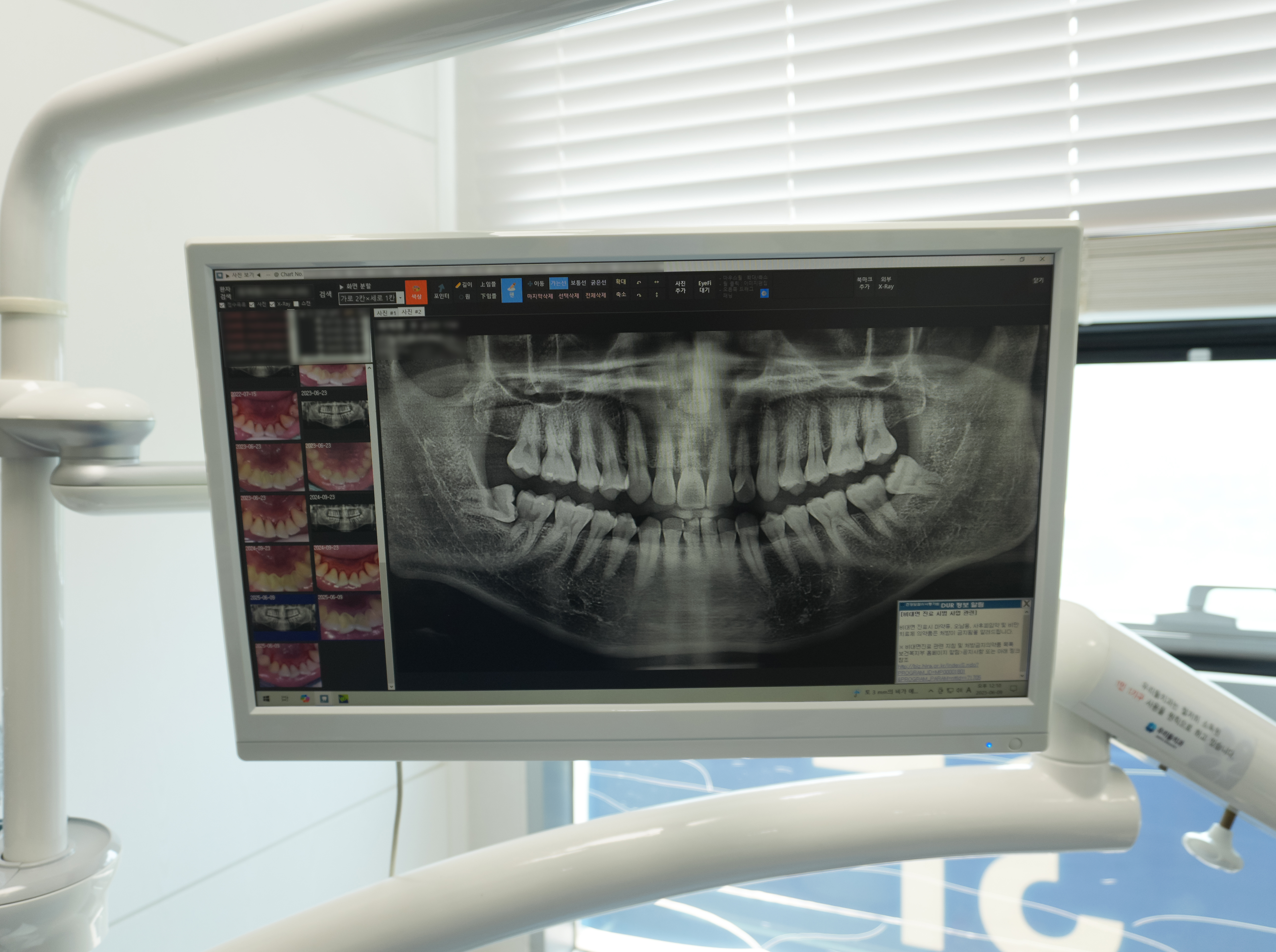 치아 X-ray