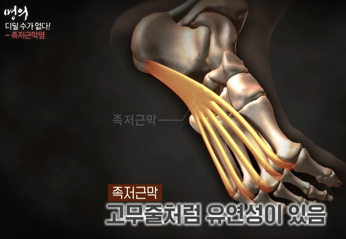 발통증-명의-최기원-교수