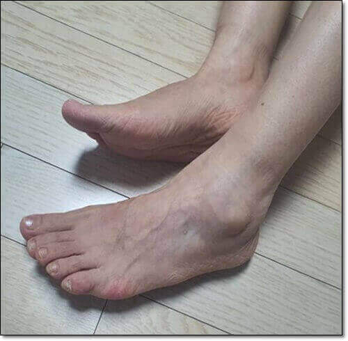 새끼발까락 휨 소건막류