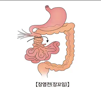 장폐색