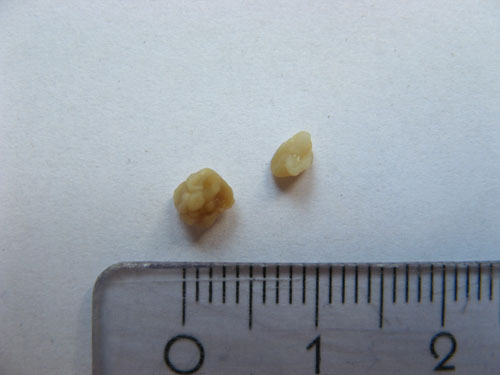 편도결석 입똥 목똥