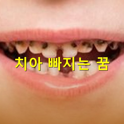 치아가-두개는-빠지고-윗니가-특히-충치가-많이-먹어-시급한-치료가-필요한-상황