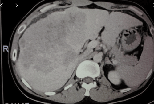 진행성 간암과 말기 간암의 차이점? 치료 방법은?